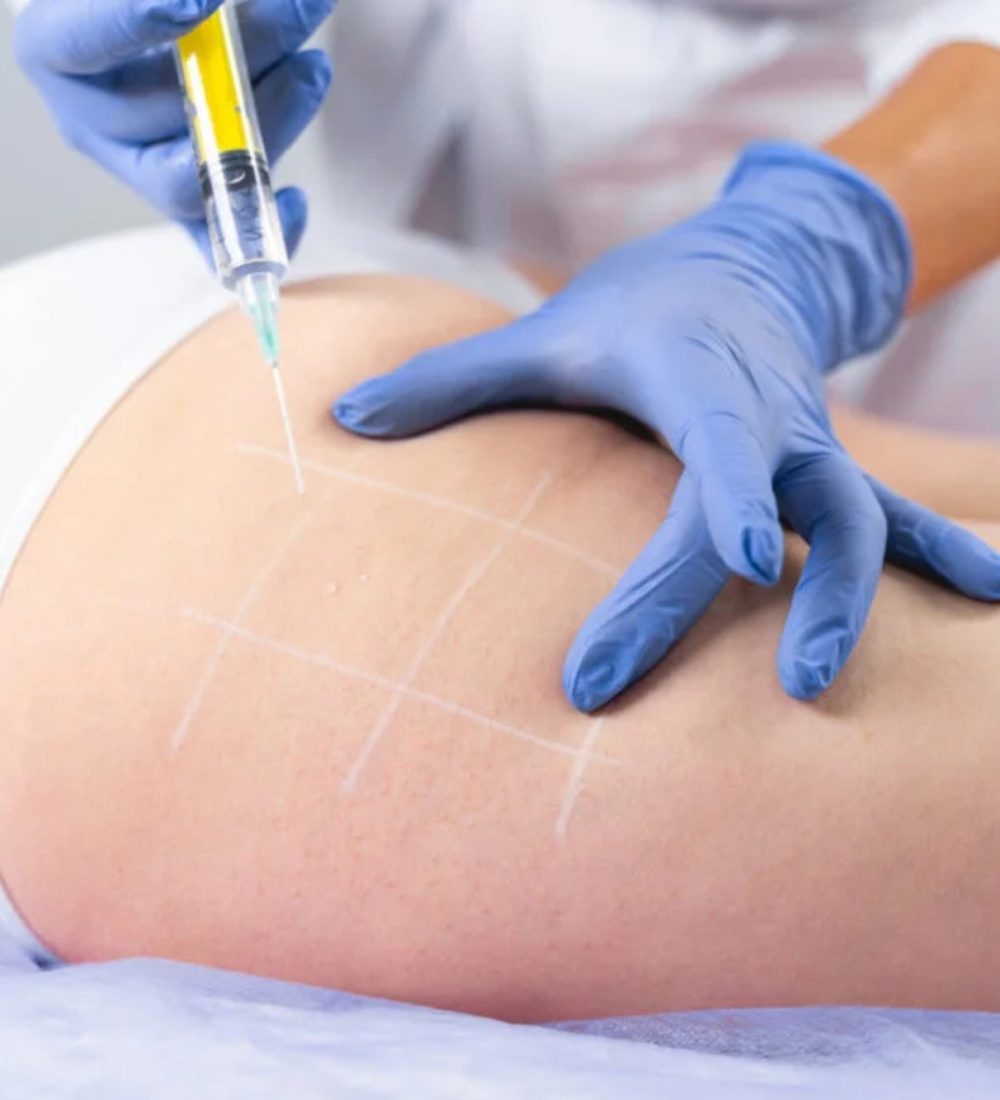 PREENCHIMENTO DE GLÚTEO